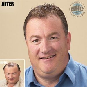 A picture of a man before and after a hair transplant