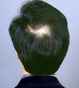 The back of a man 's head with a bald spot