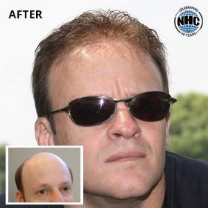 A man wearing sunglasses is shown before and after a hair transplant
