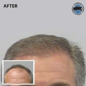 A picture of a man 's head before and after a hair transplant.