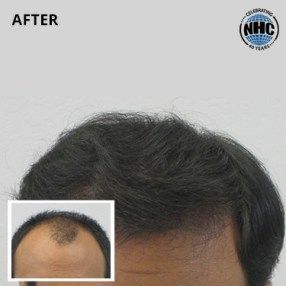A picture of a man 's hair before and after a hair transplant.