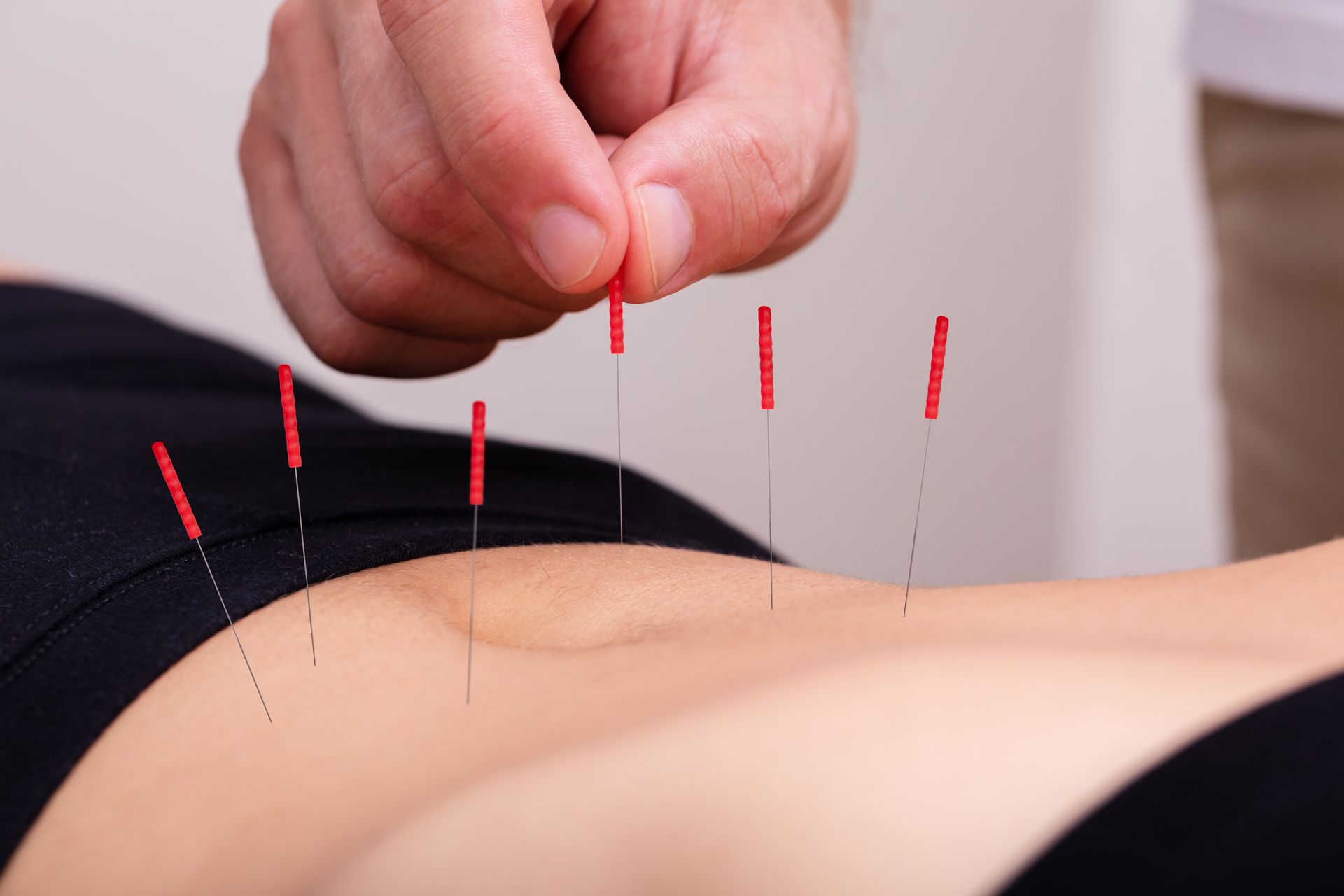 Abdominal (No Pain) Acupuncture