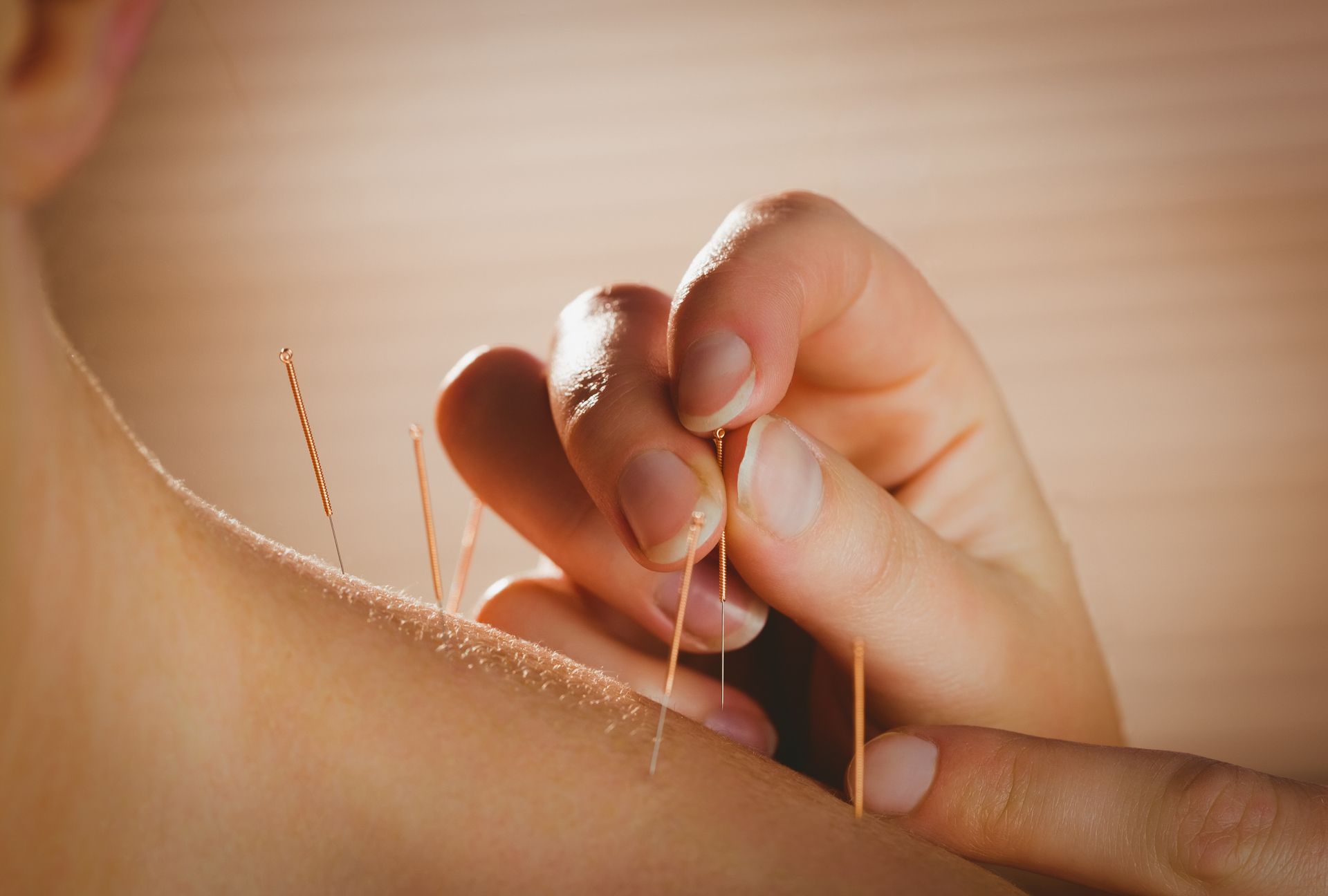 Young Woman Getting Acupuncture