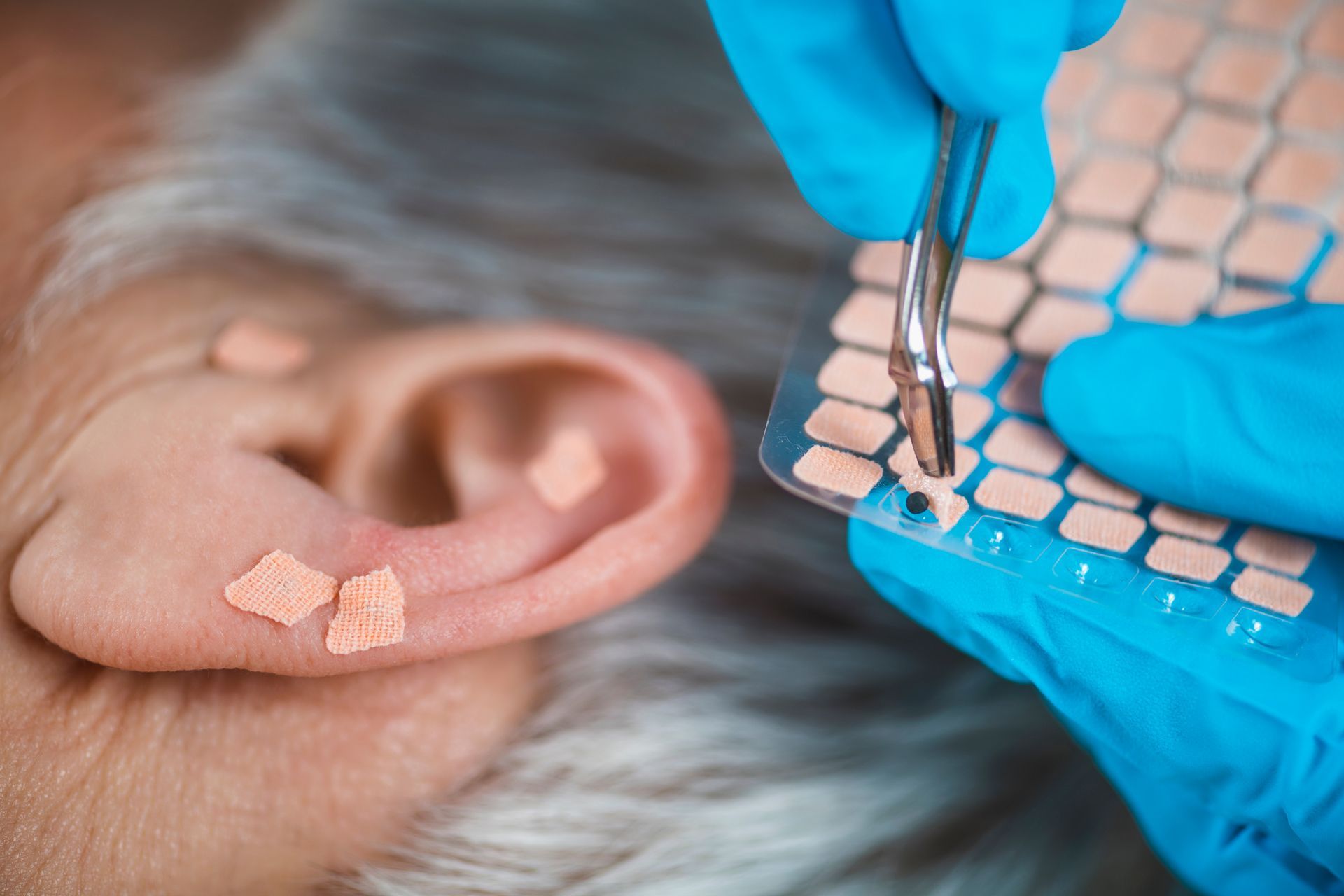 Auriculotherapy