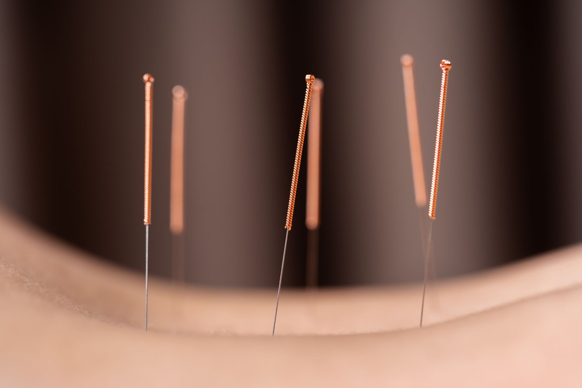 Traditional Acupuncture