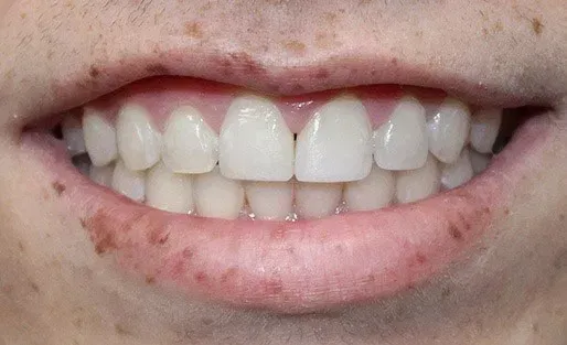 After teeth whitening image