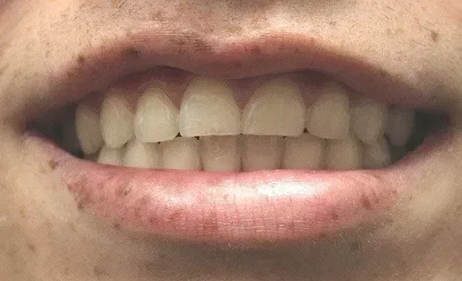 Before teeth whitening image