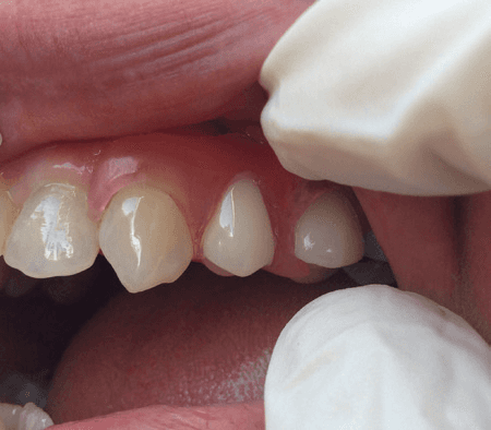 tooth replacement