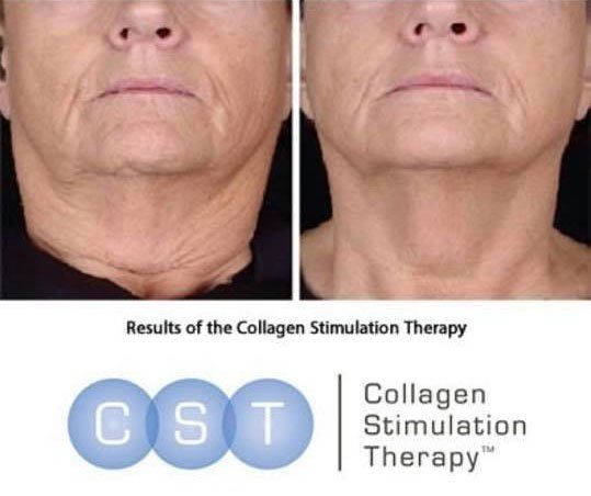 Image of CST (collagen stimulation therapy)