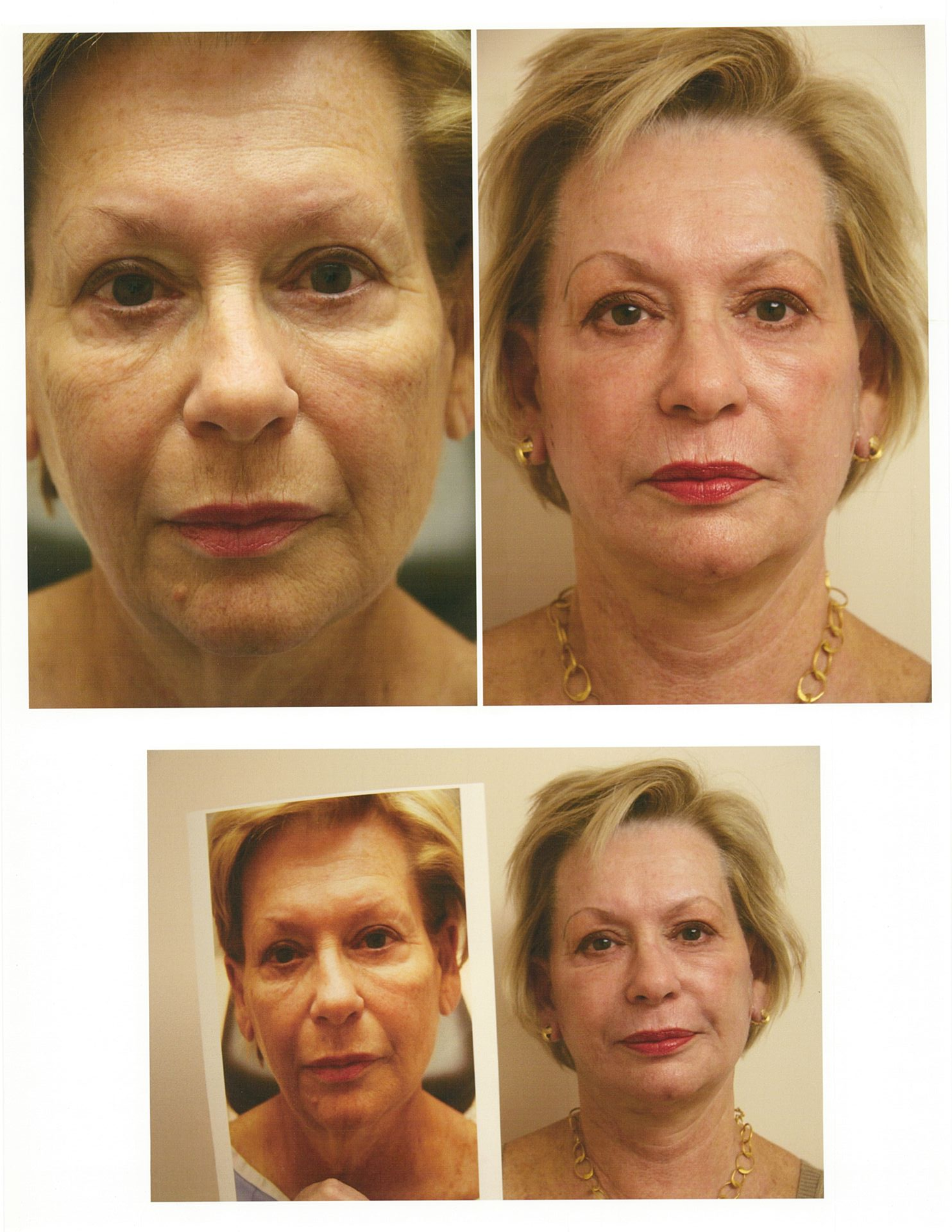 Before and after photos of a woman's face, showing a reduction in wrinkles and a refreshed appearance.