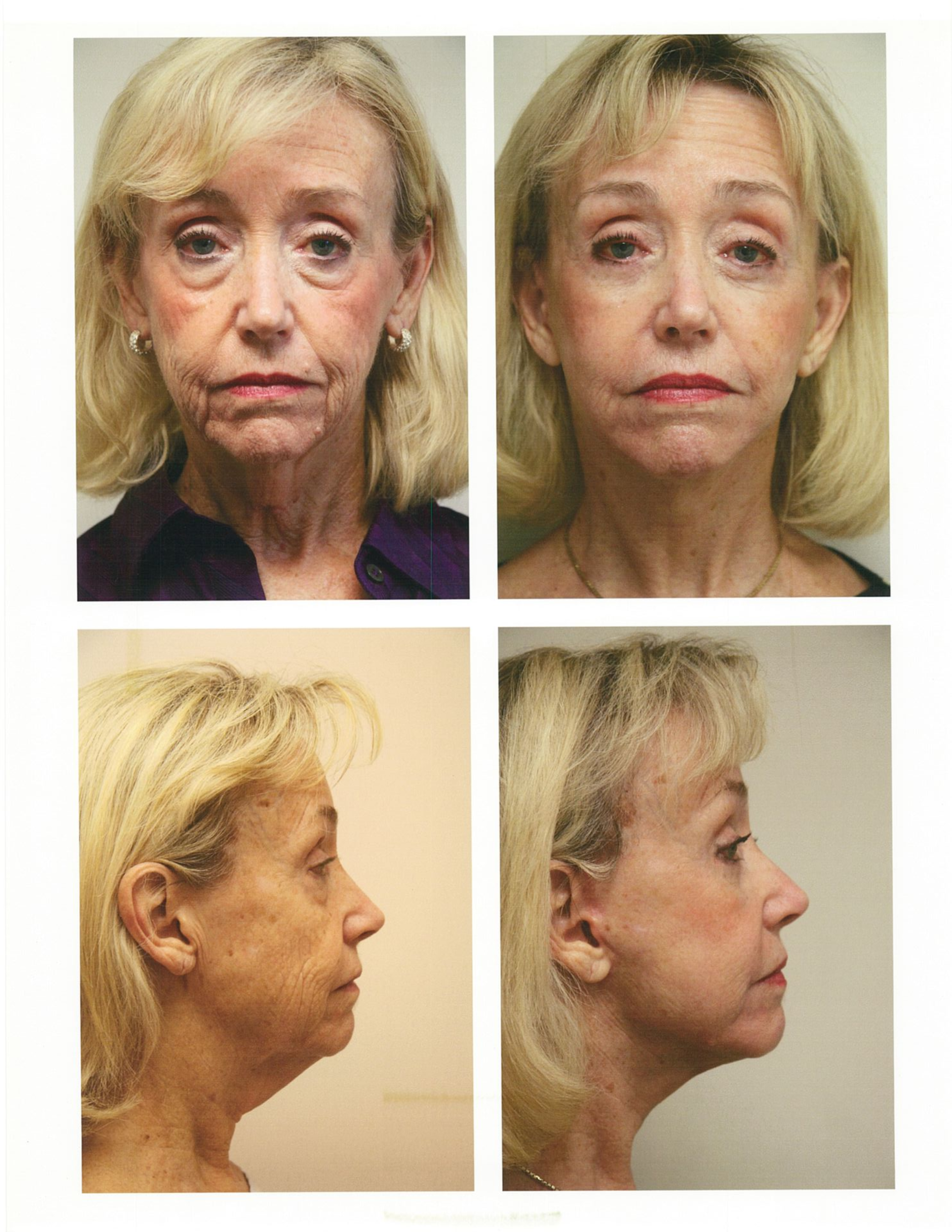 Before and after facial rejuvenation photos of an older woman, showing a smoother, lifted appearance.