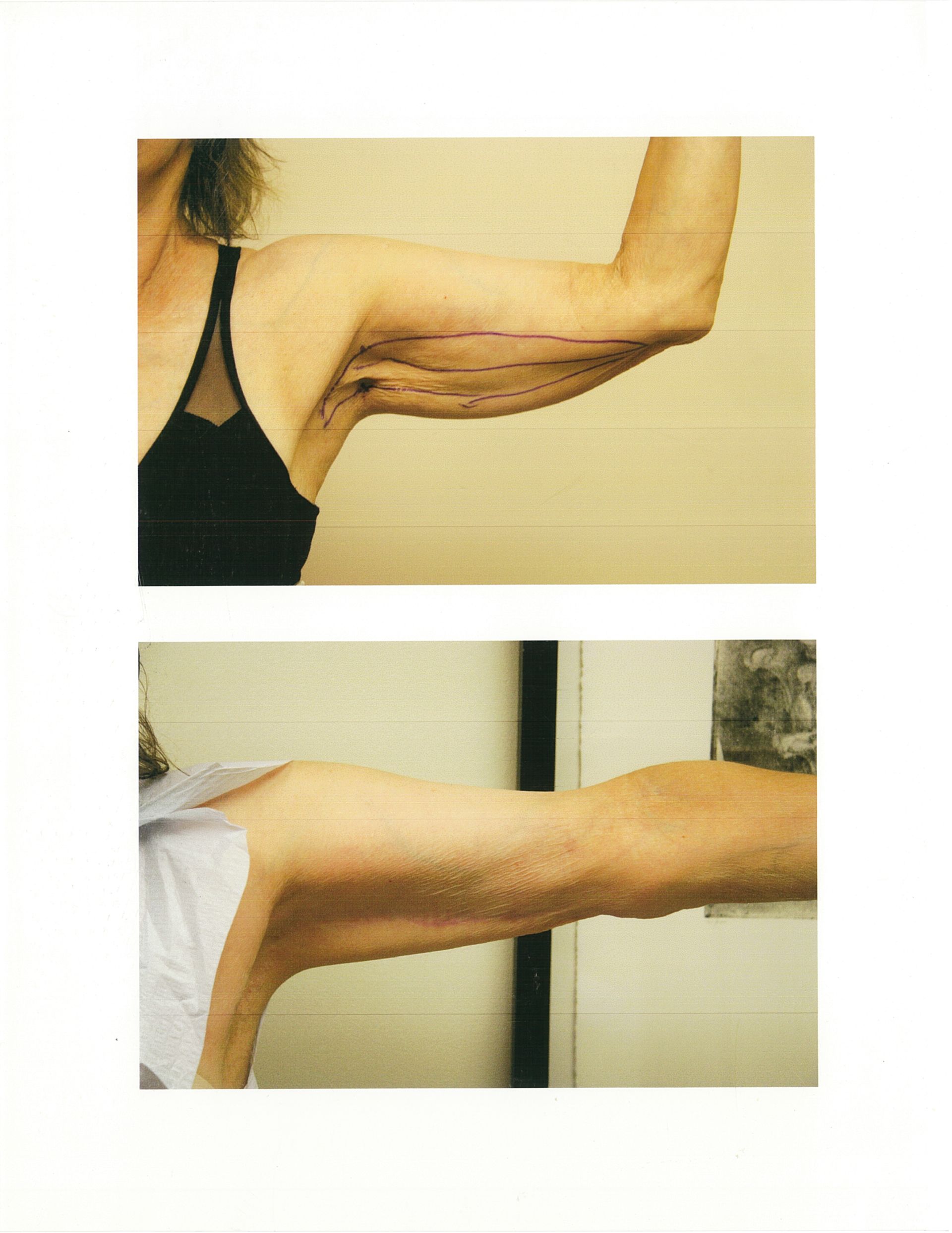 Before and after arm lift showing loose skin removal.