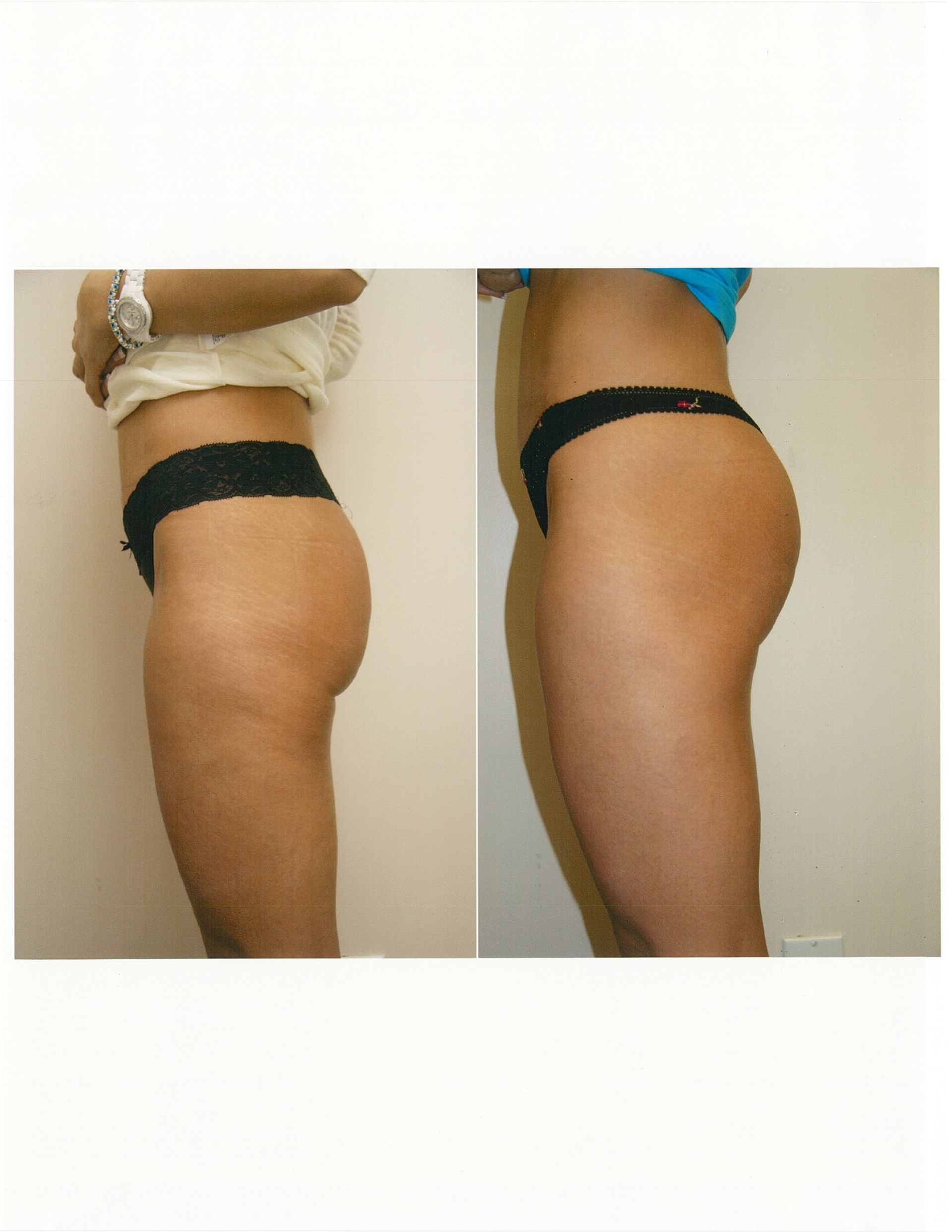 Comparison of a woman's backside, left side showing cellulite before, right side smoother.