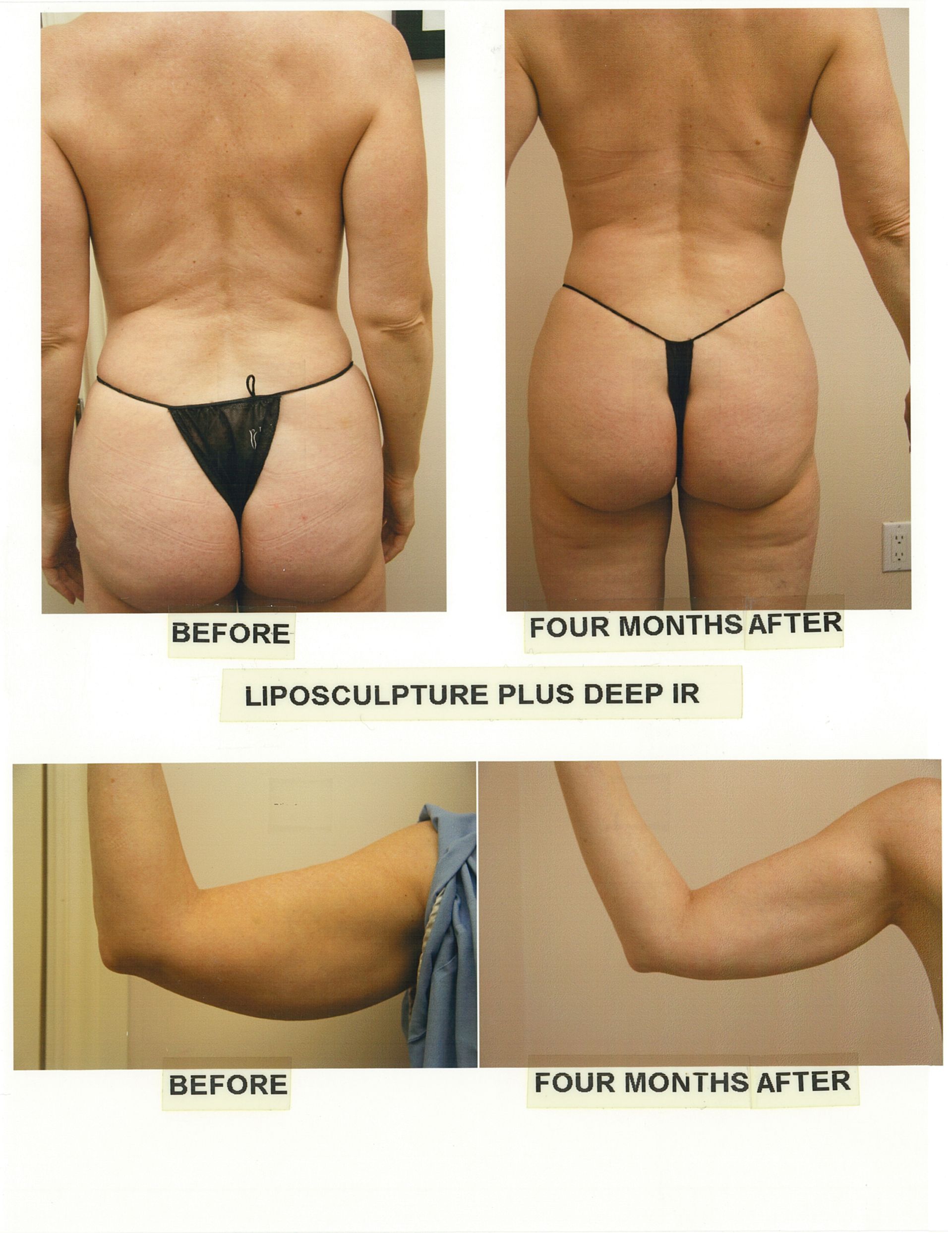 Before and after comparison of liposculpture on a woman's back and arm.