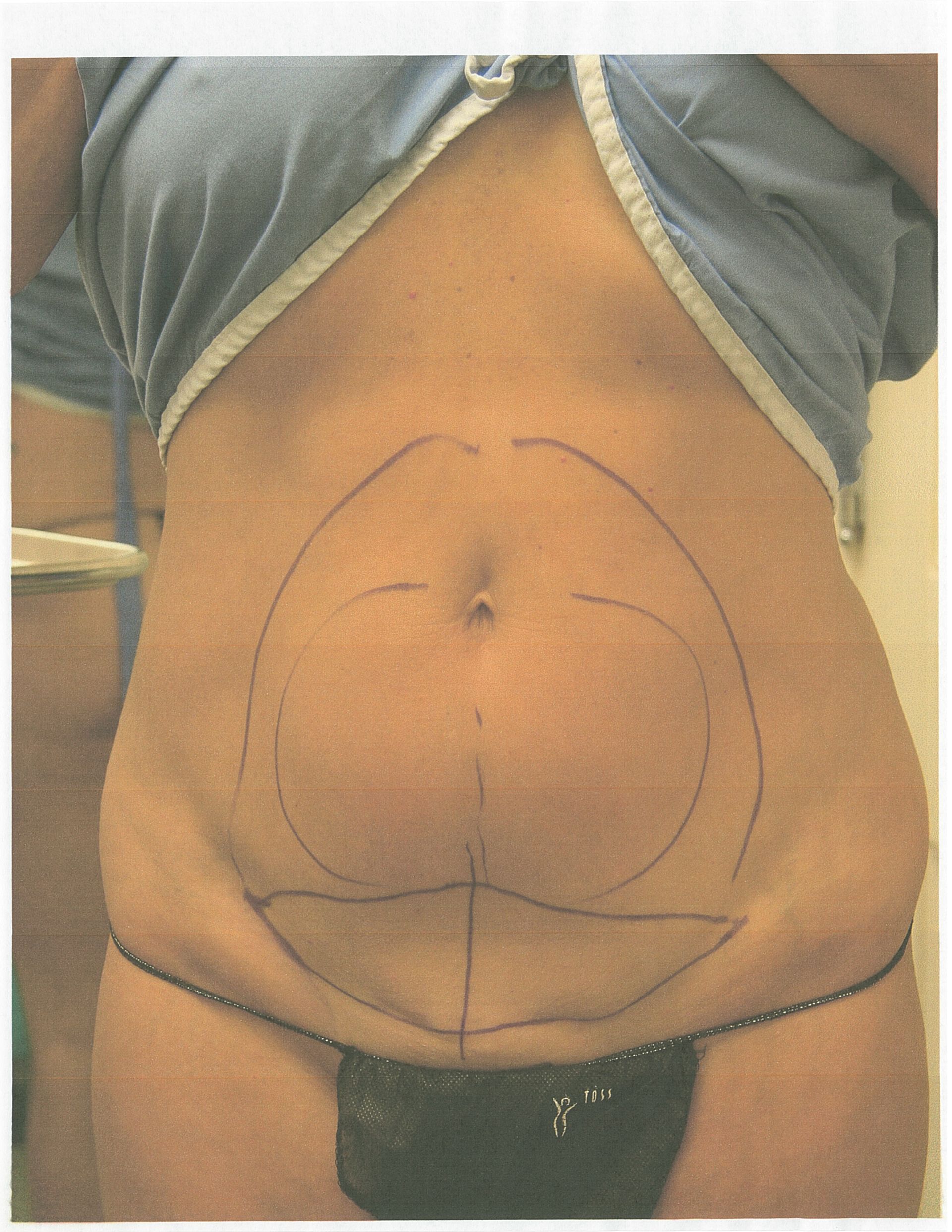 A person's abdomen marked with lines, possibly for a surgical procedure, viewed from chest to upper thighs.