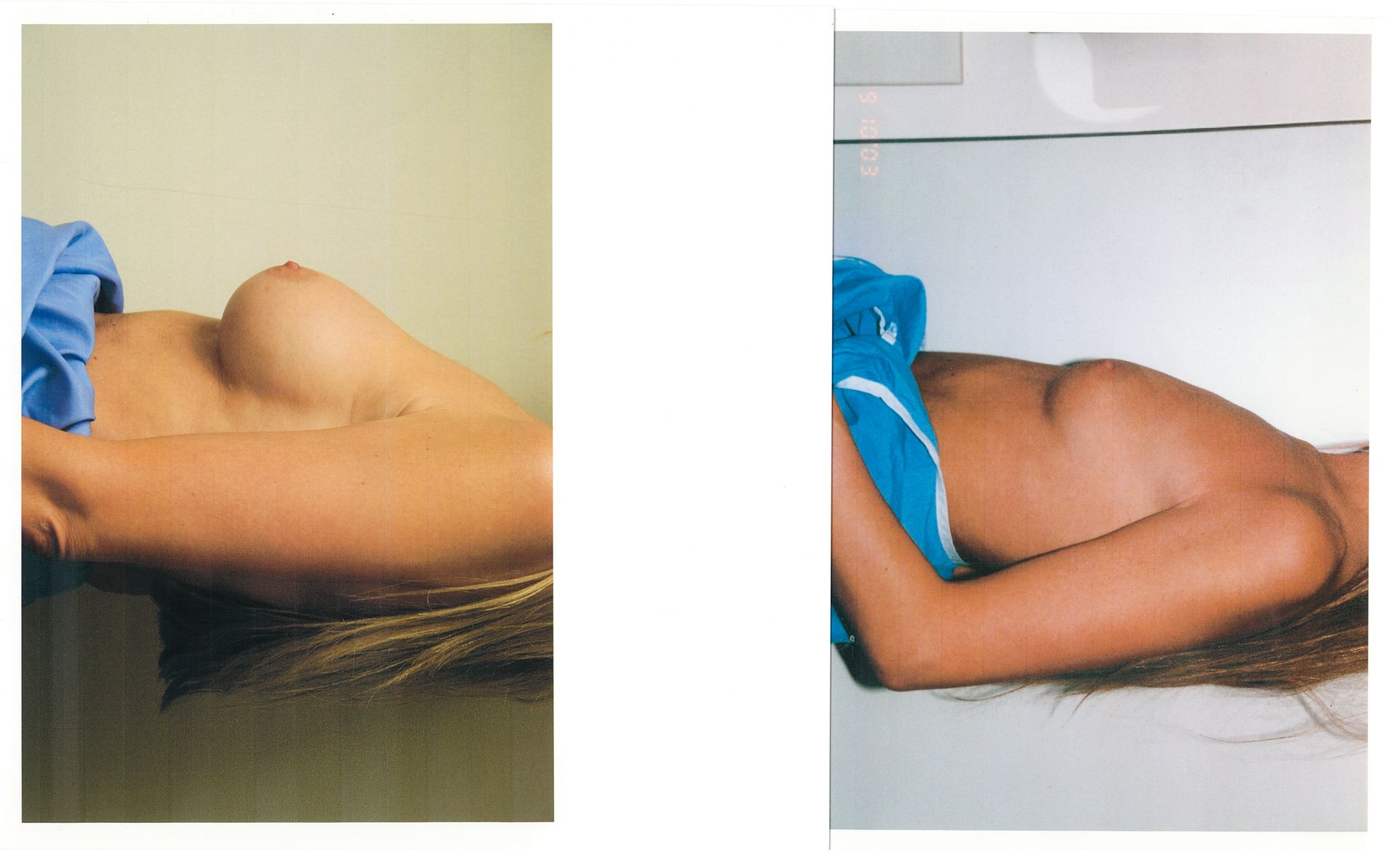 Two side views of a woman lying down with arms extended. The first shows a breast, the second shows the shoulder.