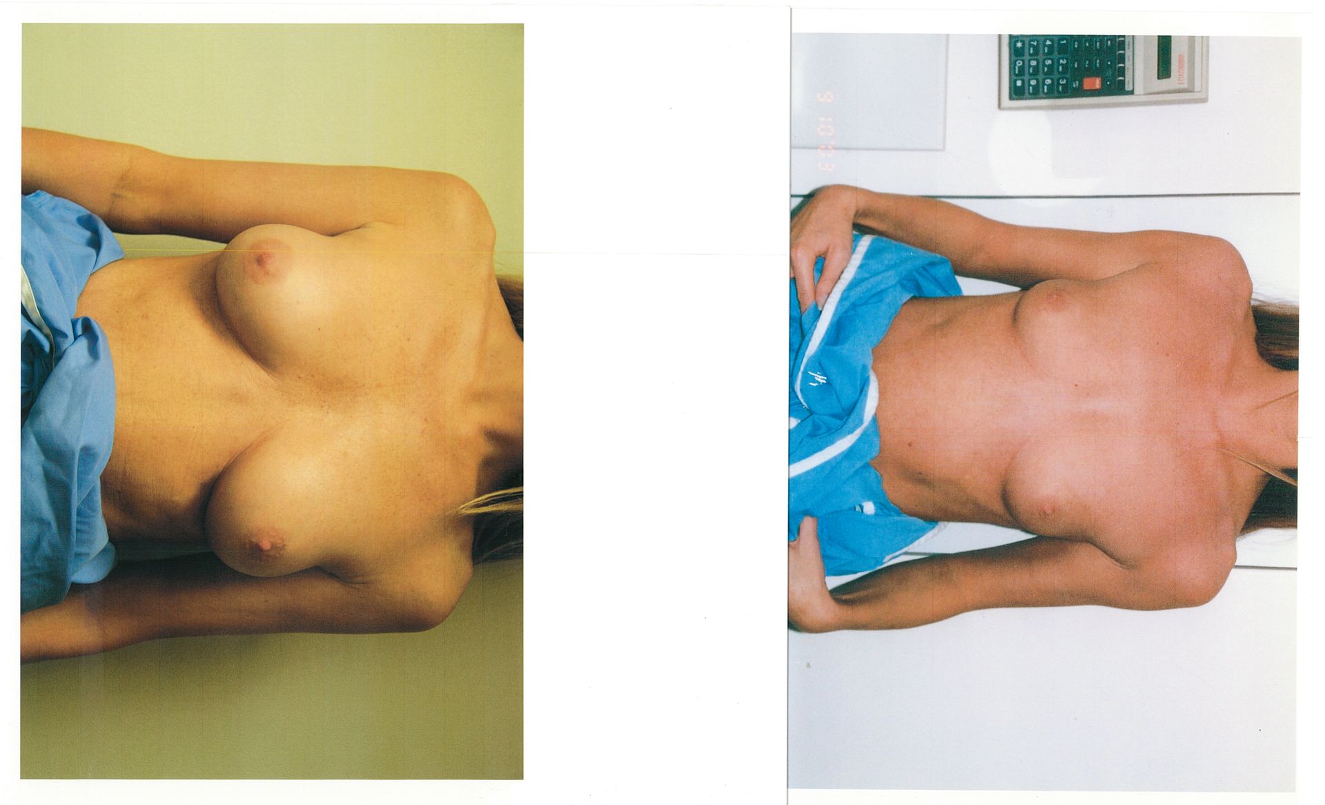 Two images side-by-side. Left: woman's torso, blue clothing, breasts exposed. Right: woman's torso, blue shorts, lying down.