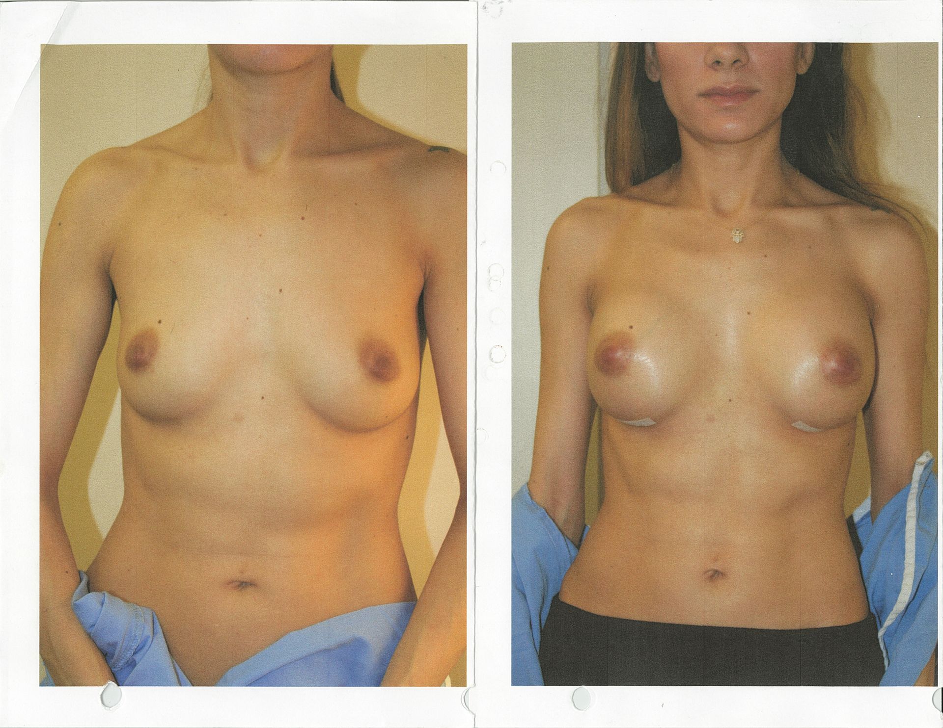 Before and after images of a woman's breasts, appearing larger after a procedure, likely augmentation.