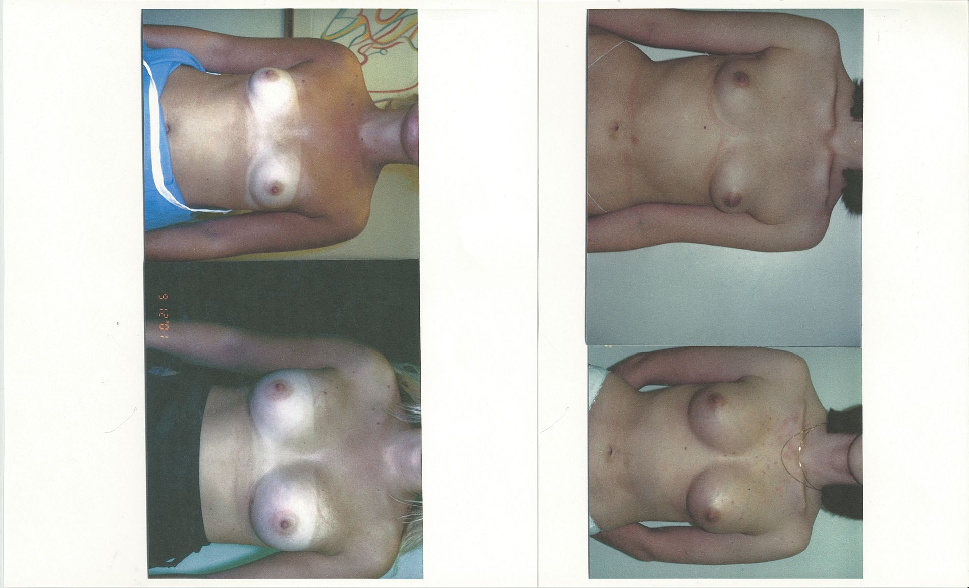 Two photos, each with two views of a woman's torso, possibly before and after a procedure.