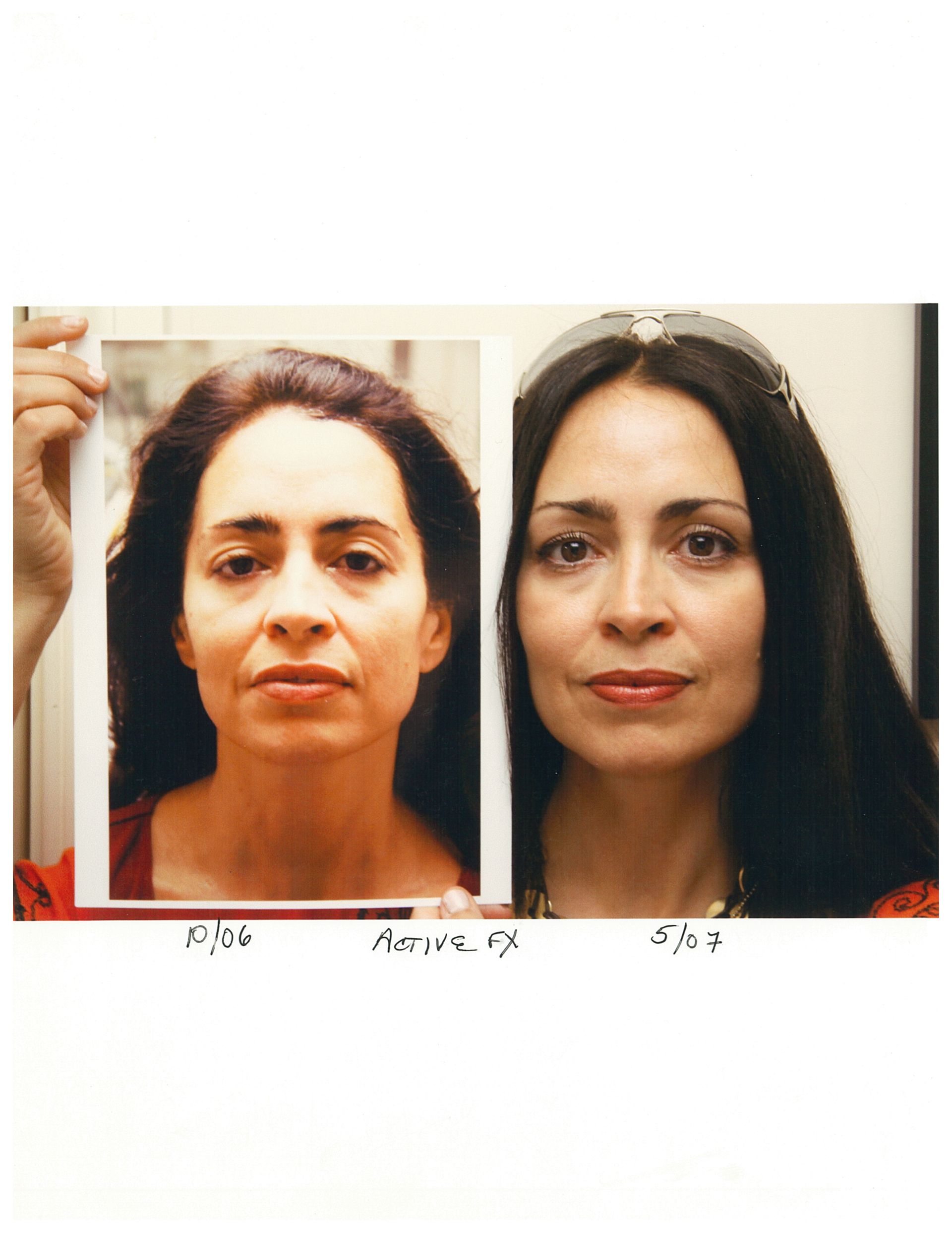 Side-by-side portraits of a woman, before and after apparent cosmetic work.