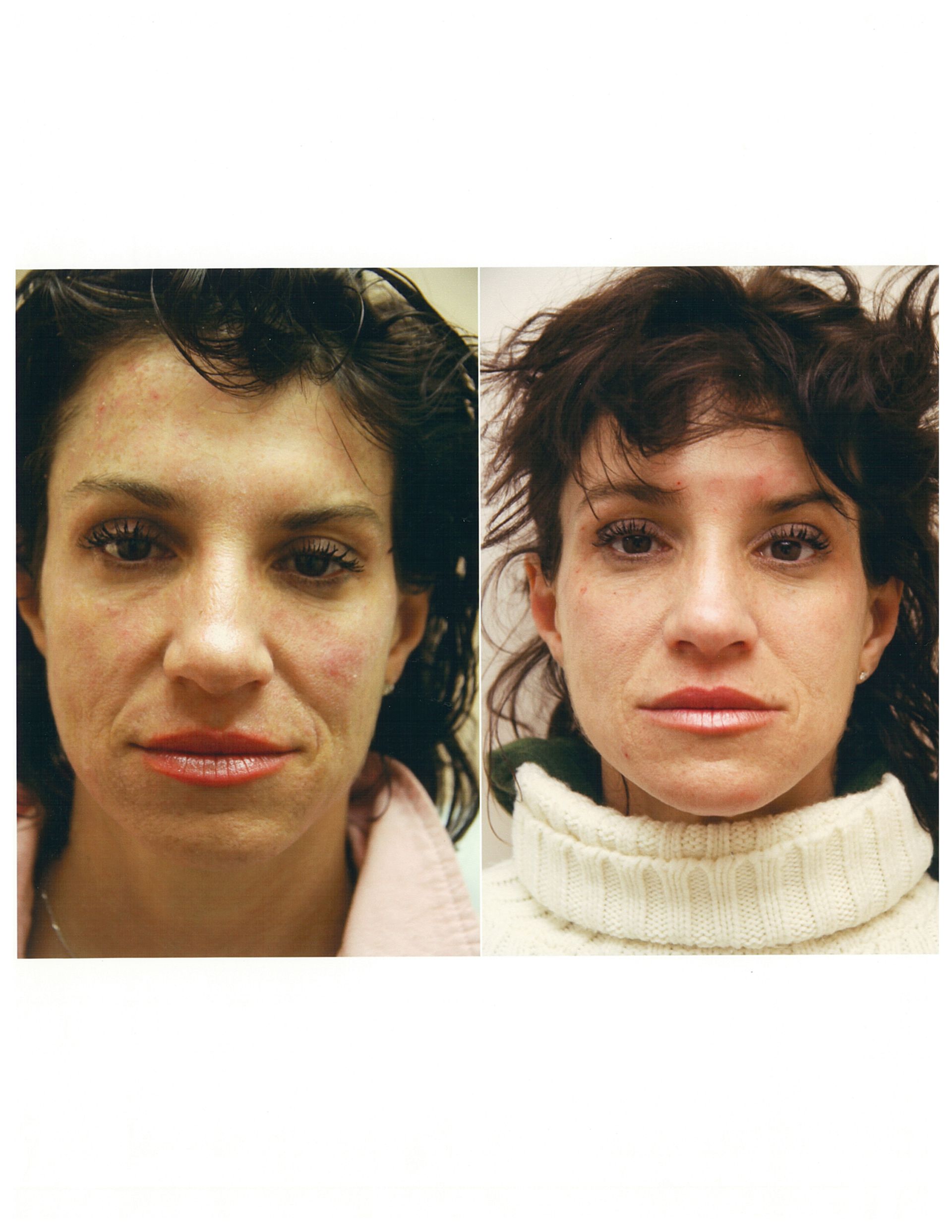 Before-and-after facial photos showing a woman's skin improving after a cosmetic procedure.