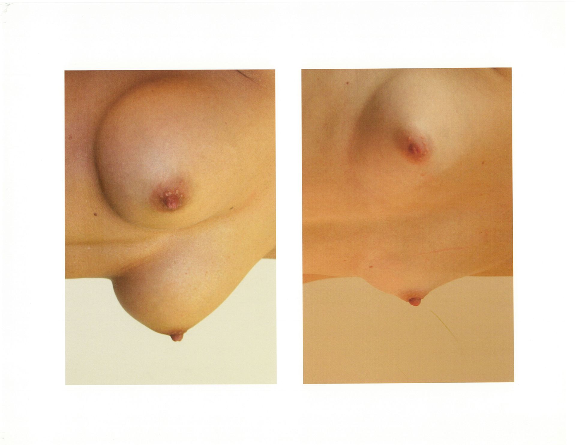 Two close-up photos side by side of breasts, with visible nipples, on a white background.