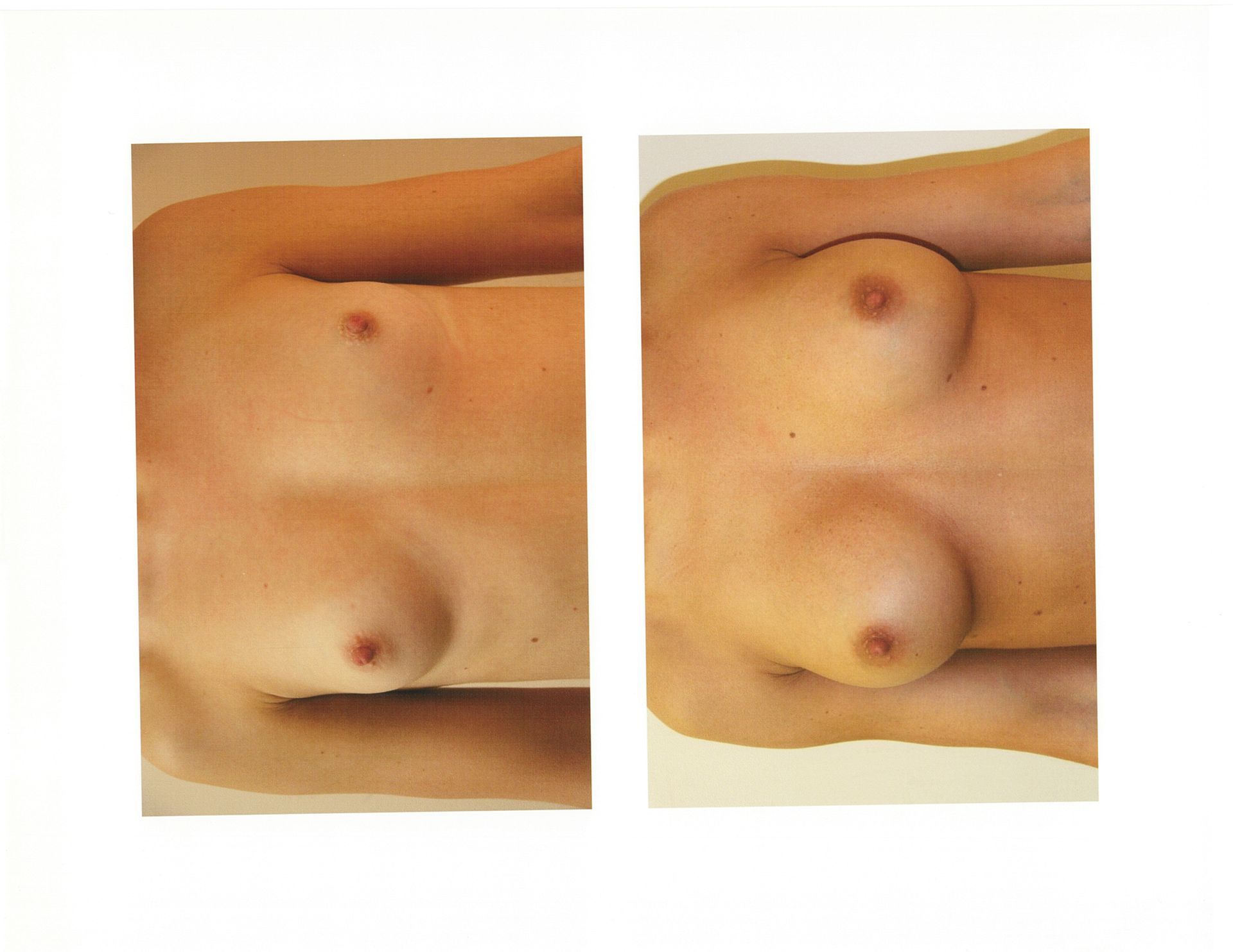Two panels showing a person's chest, left side natural, right side enhanced, with visible breast augmentation.