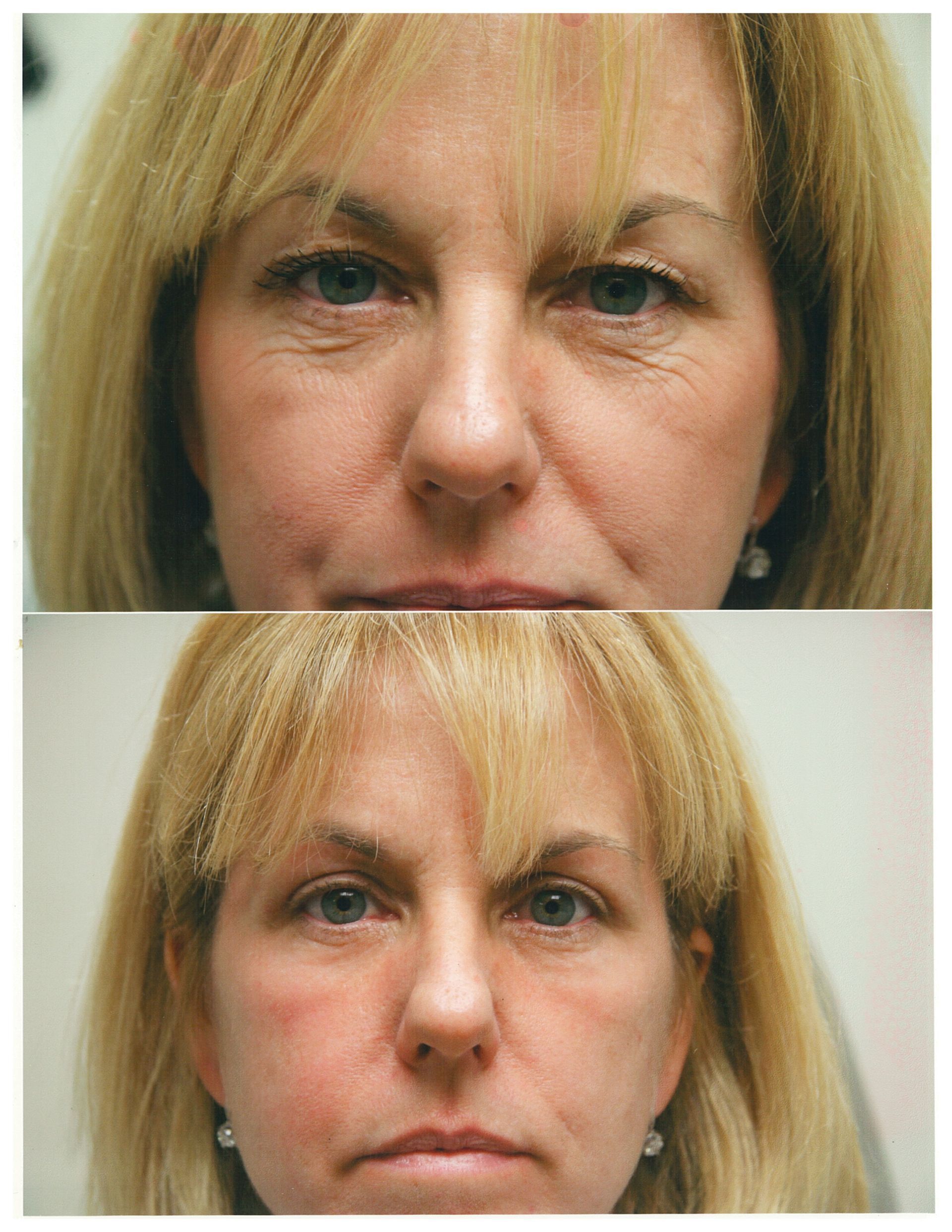 Before and after photos of a woman's face. Wrinkles are reduced in the after photo.