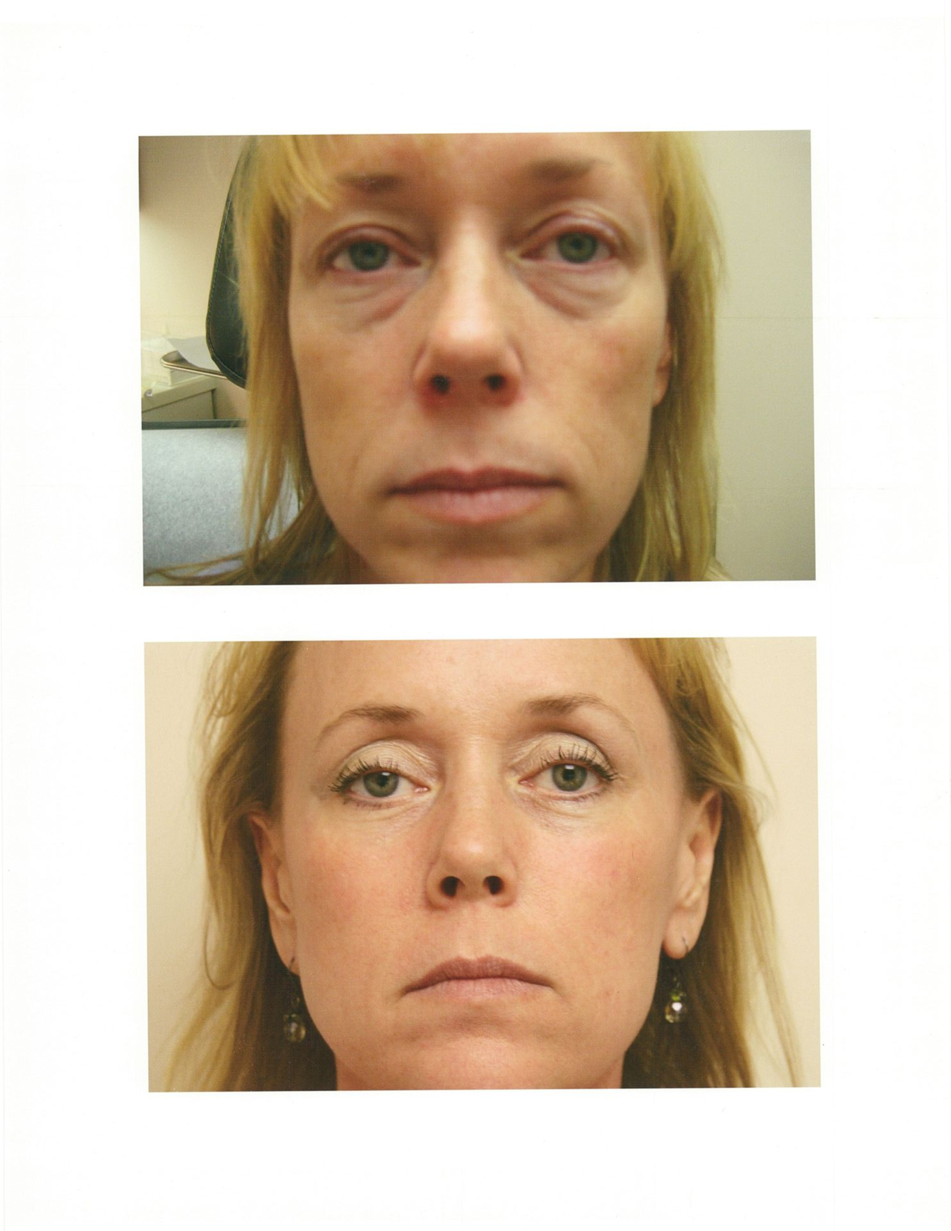 Woman's face, before and after. Dark circles under eyes reduced in the 