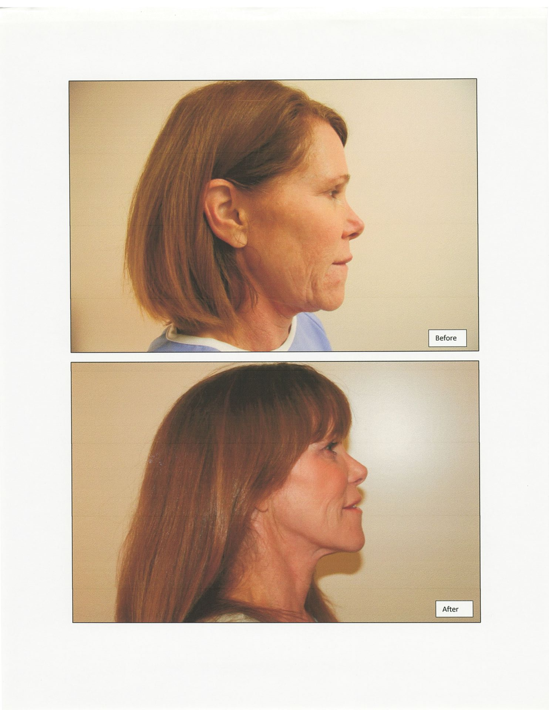 Side-by-side comparison of a woman's profile before and after a cosmetic procedure; top: shorter hair, bottom: long hair.