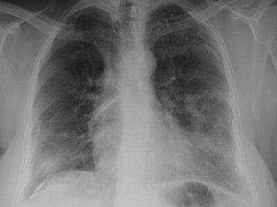 Lungs X-ray - Asbestos Removal Near Darwin