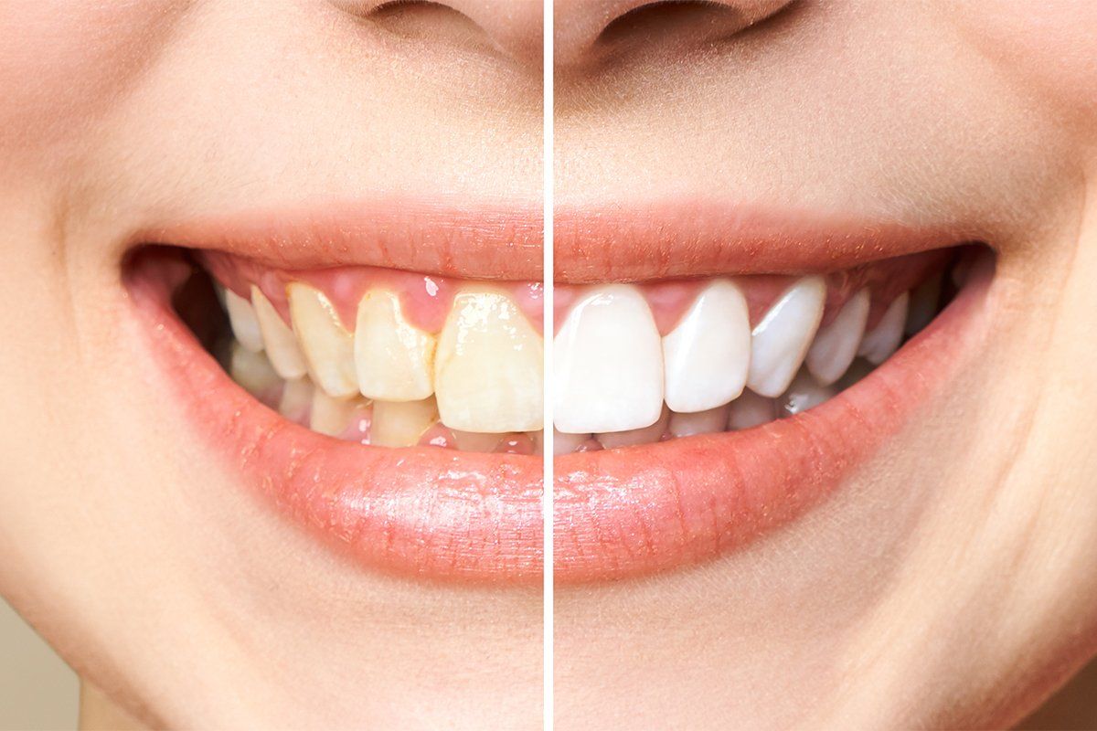 teeth whitening