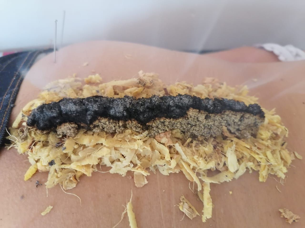 Persona recibiendo tratamiento de moxibustión en la espalda, con hierbas ardientes y agujas de acupuntura.