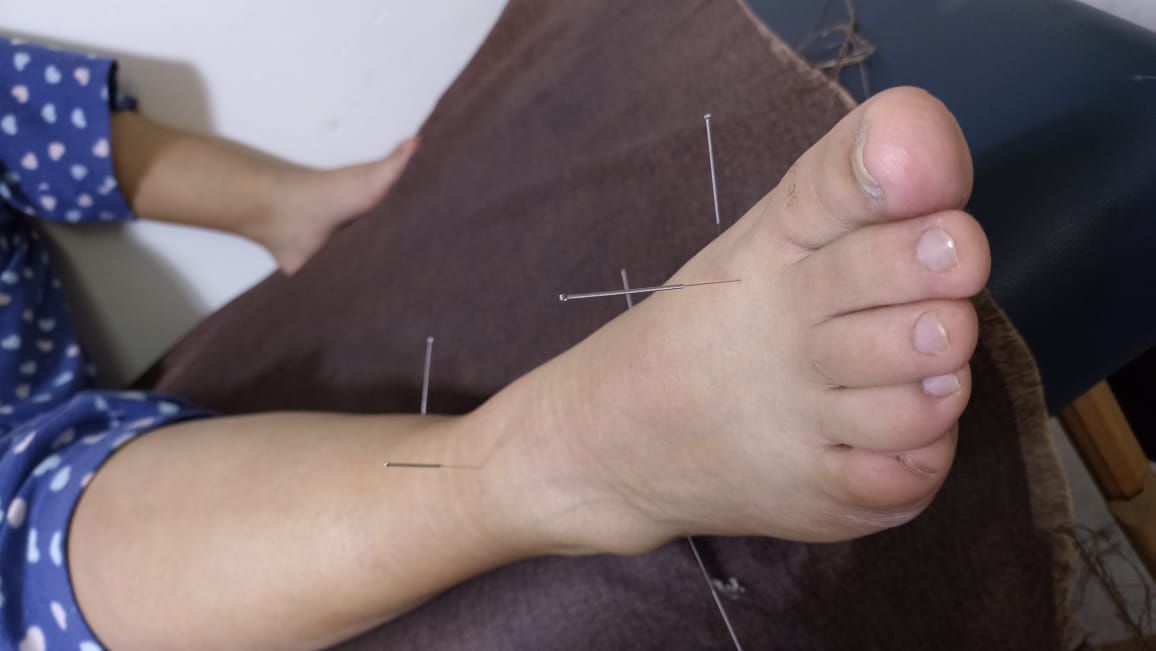 Pie con agujas de acupuntura insertadas para tratamiento.