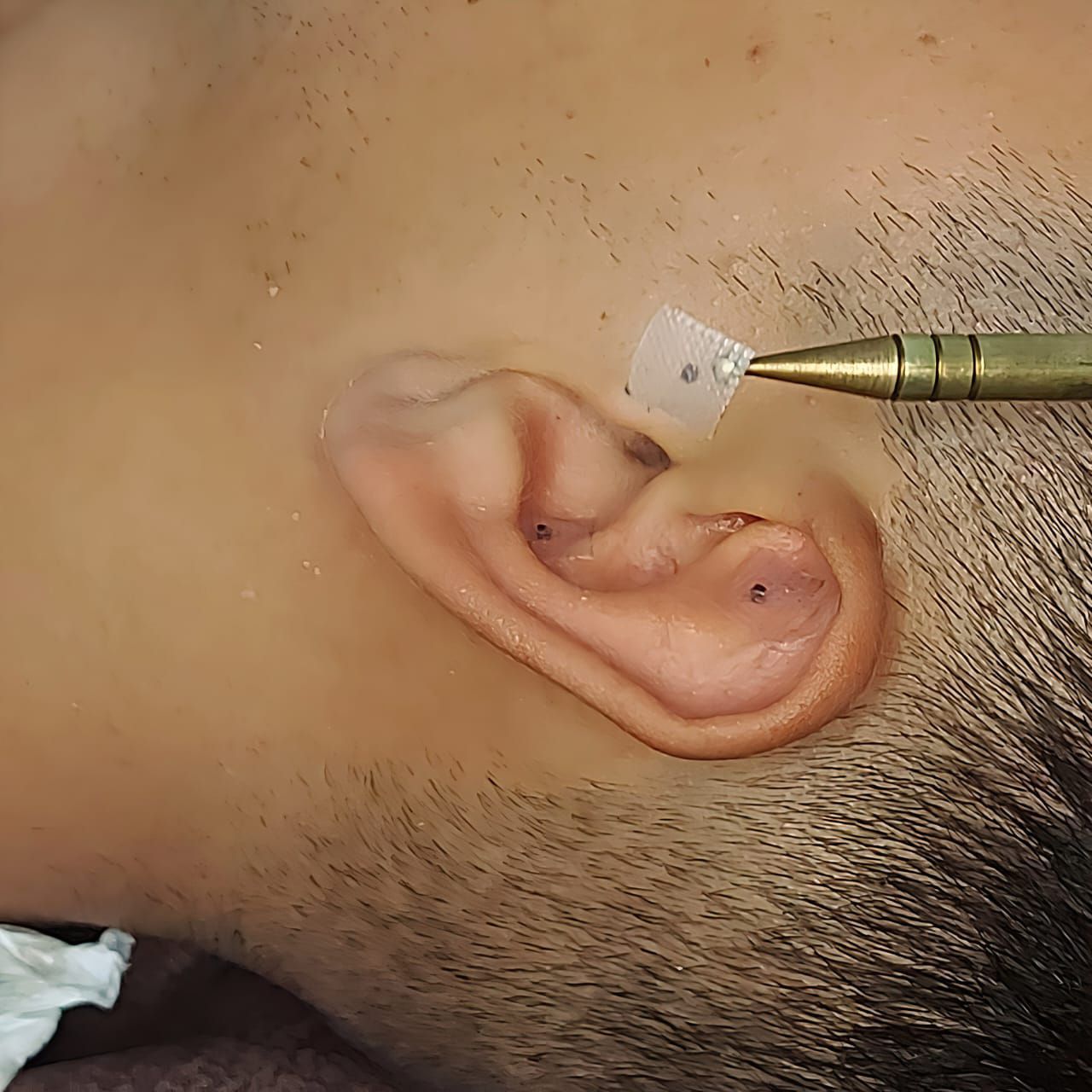 Primer plano de la oreja de una persona con pequeñas agujas insertadas para acupuntura. Un instrumento contiene más agujas.