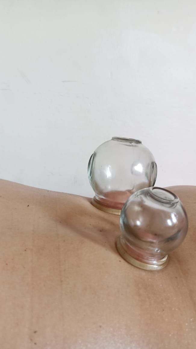 Dos ventosas terapéuticas en la espalda de una persona; vidrio transparente con fondo claro.