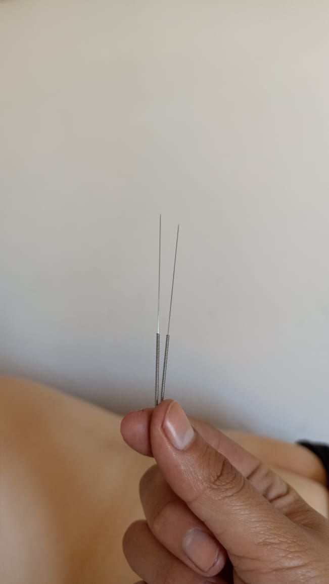 Mano sosteniendo dos agujas de acupuntura sobre un fondo blanco.