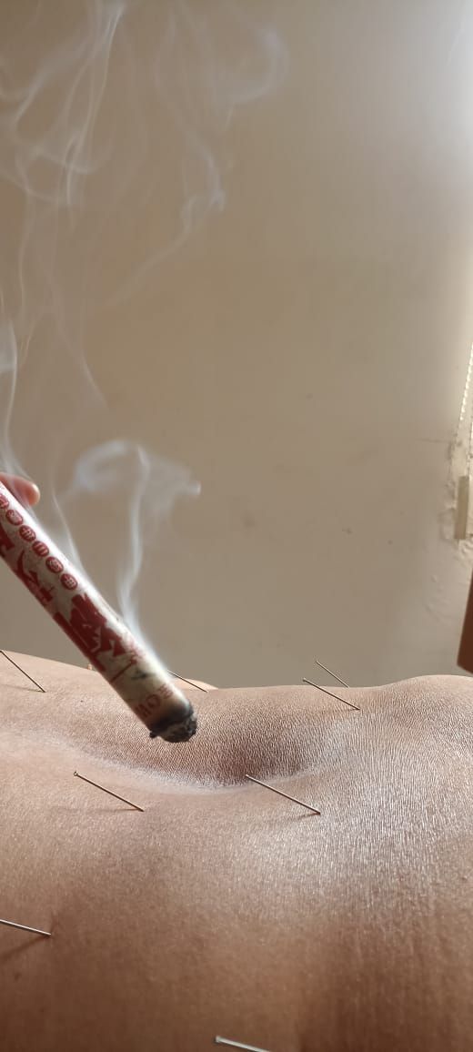 Tratamiento de acupuntura con una barra de moxa encendida que crea humo sobre agujas que se insertan en la espalda de una persona.