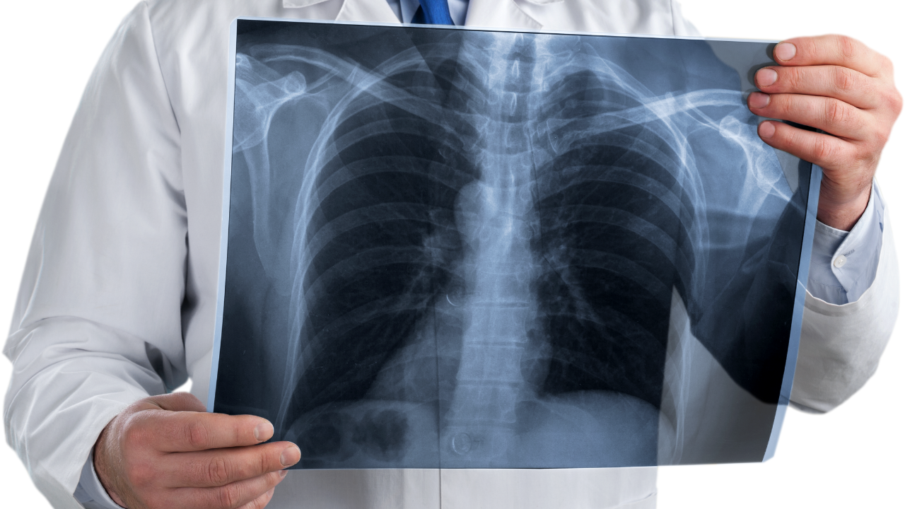 How Critical Are X-Rays in the Early Detection and Management of Cancer?