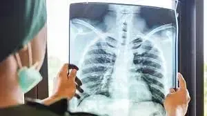 Médico analisando radiografia para diagnóstico de pneumonia CID J18.