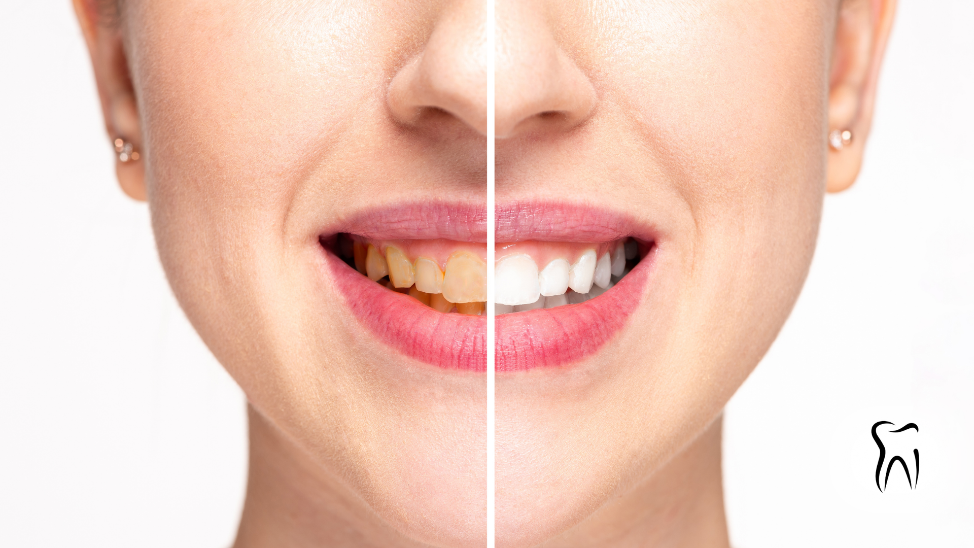 Woman's smile, showing side-by-side comparison of stained and whitened teeth.