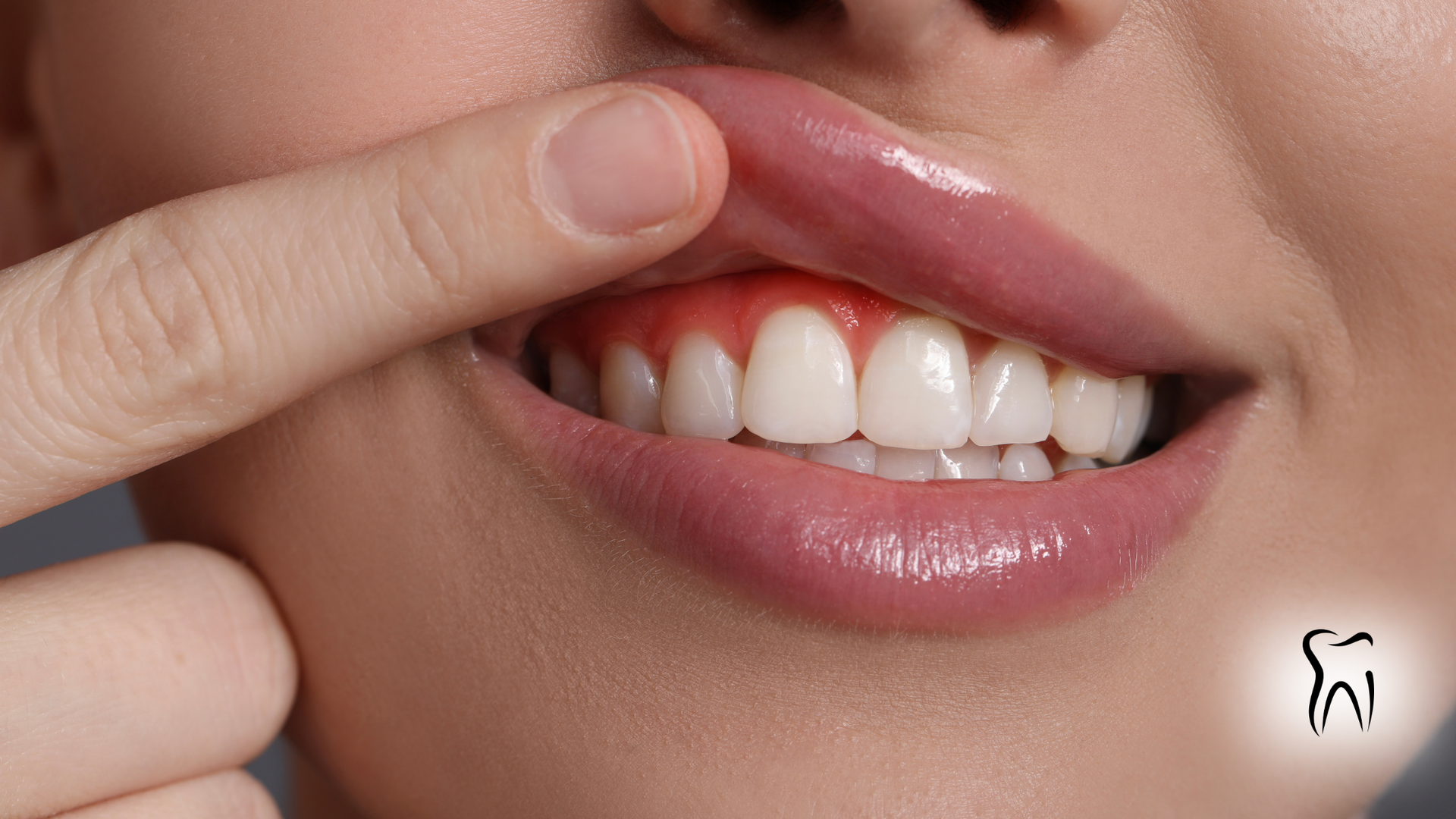 Close-up of a person's mouth with inflamed gums; finger presses on the inflamed area.