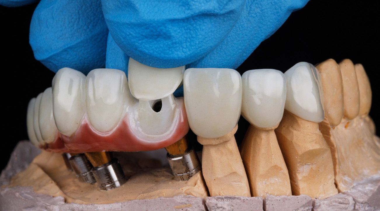 Dental model showing implant bridge held by a gloved hand.