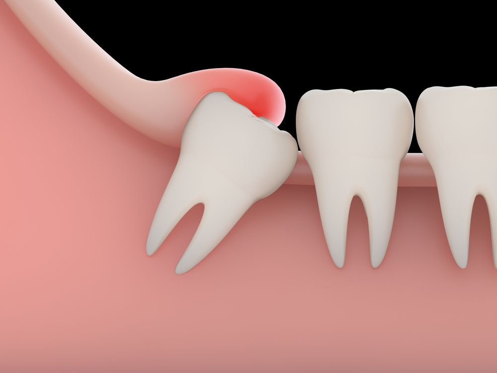 Illustration of an impacted wisdom tooth pushing against adjacent molar, red inflammation present.