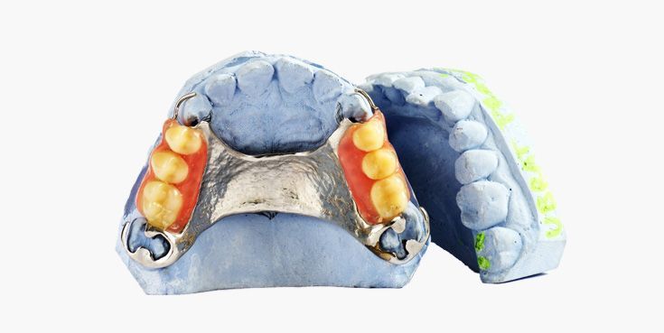 Dental mold with teeth, metal framework, and blue and green plaster.