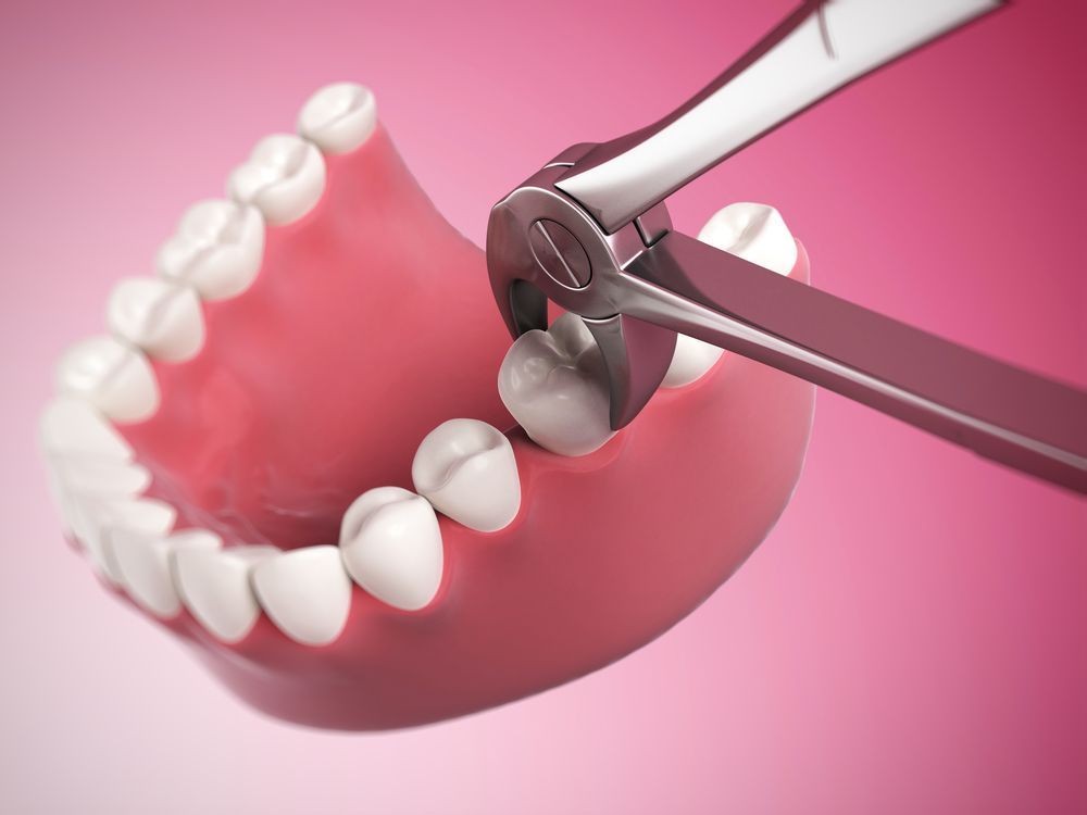 Tooth being extracted with dental forceps from a pink gum line.