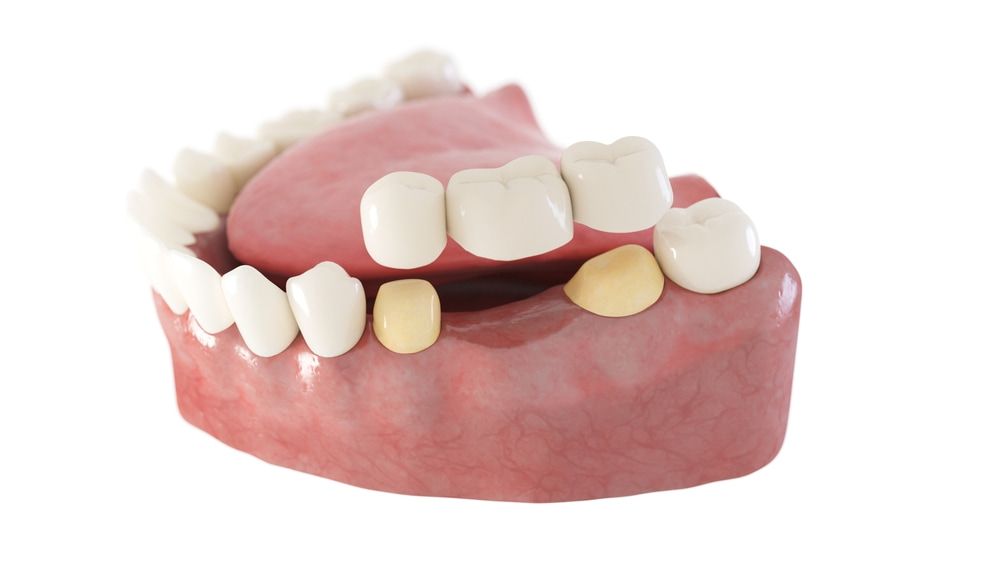 A Model of A Person 's Teeth with A Dental Bridge — Bromley's Denture Clinic in Tweed Heads South, NSW