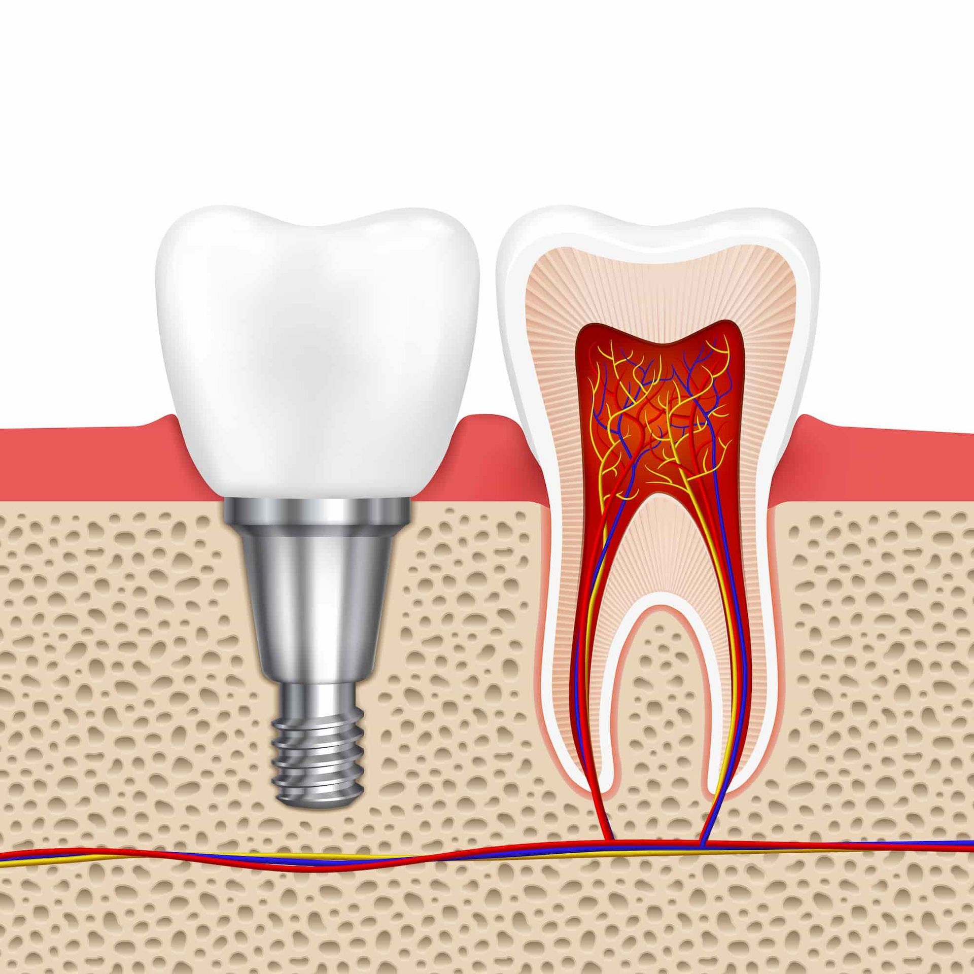 A Diagram of A Tooth with A Dental Implant in It — Bromley's Denture Clinic in Tweed Heads South, NSW