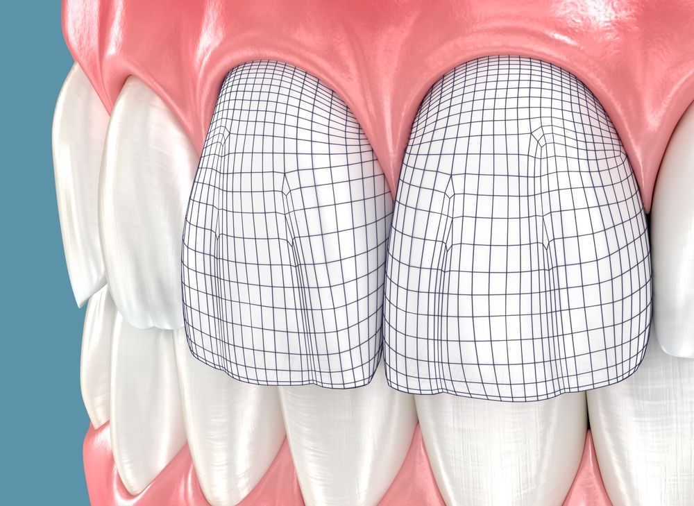 Dental Illustration of Front Teeth With Grid Patterns Overlaying Them — Bromley's Denture Clinic in Tweed Heads South, NSW