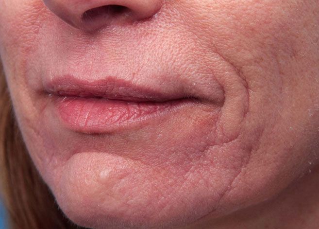 A close up of a woman 's face with wrinkles around her mouth.